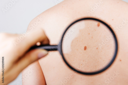 Dermatologist examining birthmark of patient, closeup. Cancer concept