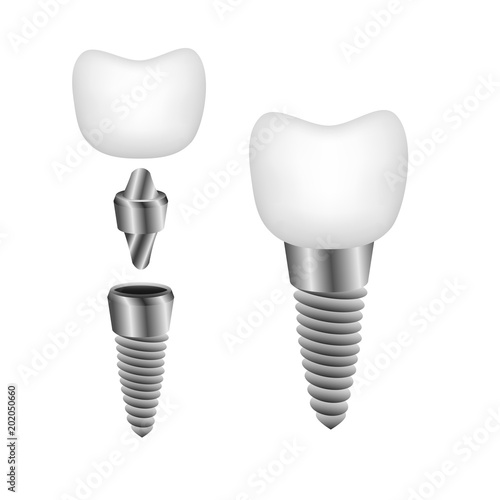 Vector illustration of dental implant for promotional booklets, flyers, banner, website of dental clinic.