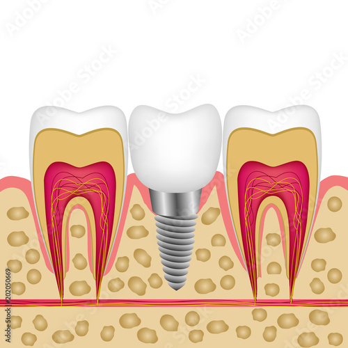 Vector illustration of a dental implant in bone between teeth for booklets, magazines, flyers, website of a dental clinic.