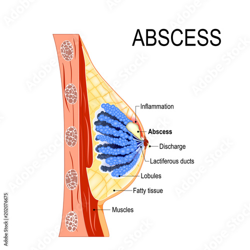 abscess. Cross-section of the mammary gland with inflammation of the breast