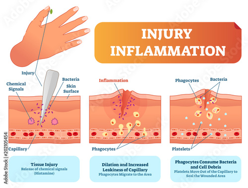 Injury inflammation biological human body response vector illustration scheme. Skin surface injury cross section poster with capillary, phagocytes and platelets.