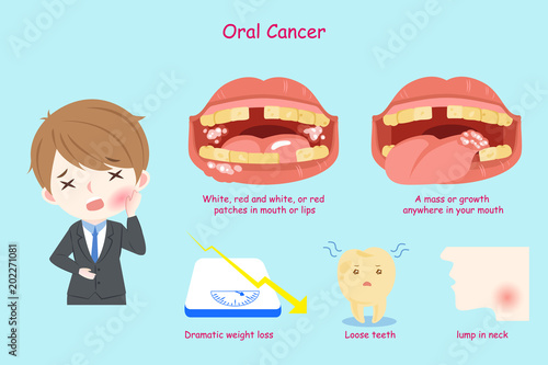 businessman with oral cancer