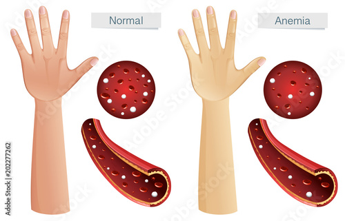 Human Anatomy Vector of Anemia