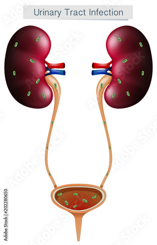 Urinary Tract Infection on White Background