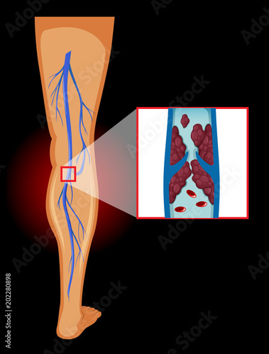 Medical Image of Varicose Veins