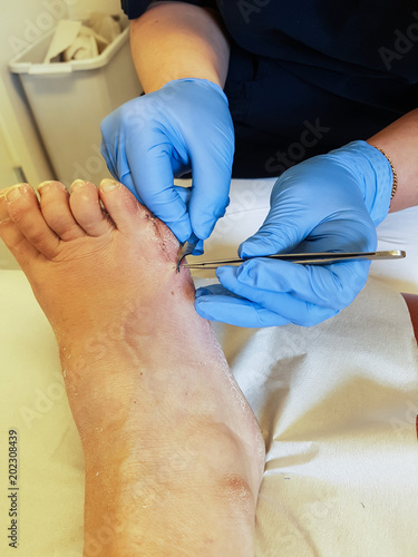 A nurse with blue surgical gloves removes stiches from the patients right foot three weeks after a bunion surgery.