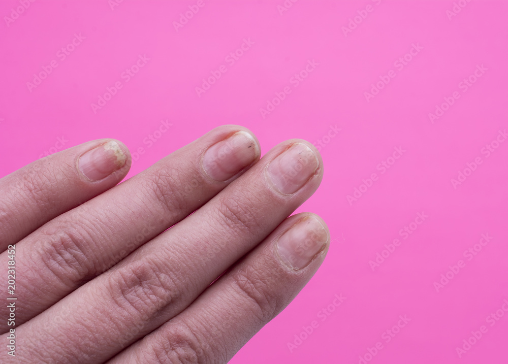 Onycholysis isolated on white background. Mechanical damage to the nail plate. Damage to the nail after applying shellac or gel-varnish (Gel-lacquer). Onycholysis isolated on white background. Mechanical damage to the nail plate. Damage to the nail after applying shellac or gel-varnish (Gel-lacquer).