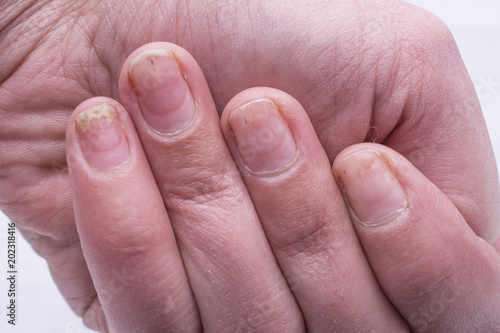 Onycholysis isolated on white background. Mechanical damage to the nail plate. Damage to the nail after applying shellac or gel-varnish (Gel-lacquer).
