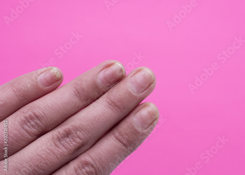 Onycholysis isolated on white background. Mechanical damage to the nail plate. Damage to the nail after applying shellac or gel-varnish (Gel-lacquer).