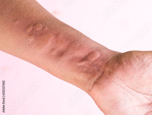 Skin Allergy Symptoms on hand photo