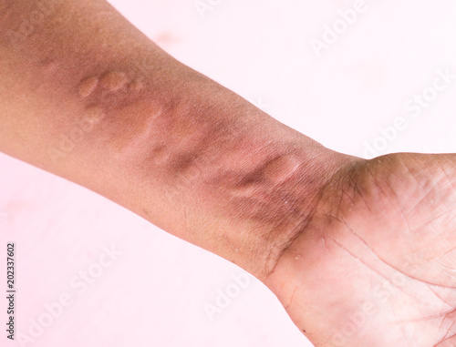 Fotografie Skin Allergy Symptoms on hand