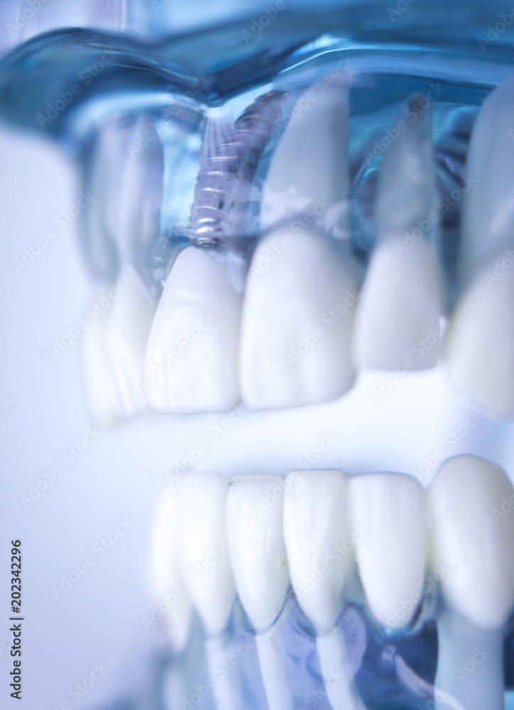 Dentsts dental tooth implant Dentsts dental tooth implant