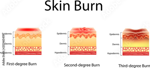 skin burn. Three degrees of burns. type of injury to skin, Vector illustration photo