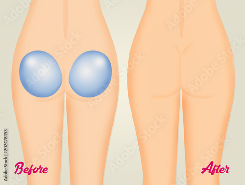 Obraz w ramie before and after buttocks remodeling
