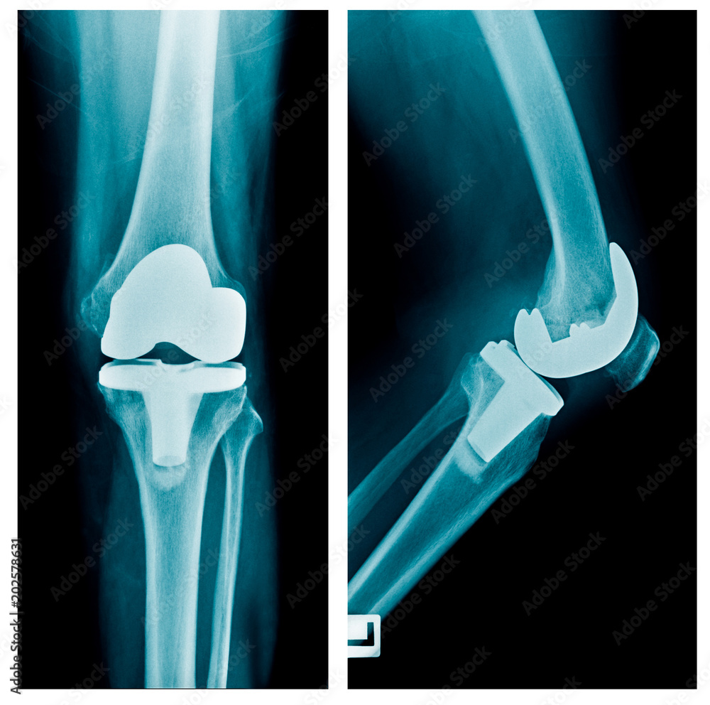 xray hip replacement or total knee arthroplasty AP and lateral view