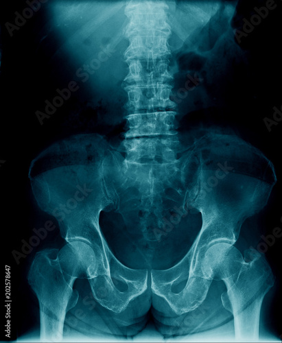 x-ray thoracic and lumbar spine and pelvic bone and hipjoint, spondylosis of body column and compression fracture of L4-5 spine photo