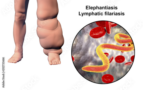 Leg of a person with elephantiasis, or lymphatic filariasis and close-up view of microfilariae in blood, 3D illustration. A disease caused by worms Wuchereria bancrofti, transmitted by mosquito bite photo