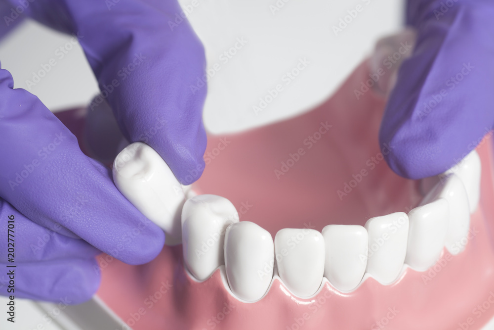 Dental model teeth is used to demonstration of tooth extraction by doctors Dental model teeth is used to demonstration of tooth extraction by doctors