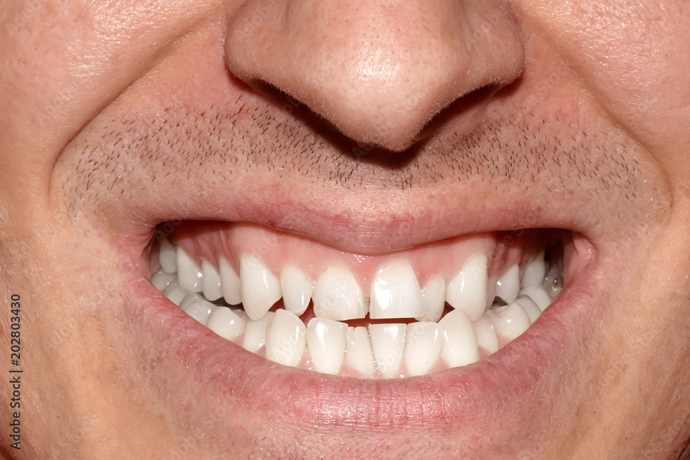 Ταπετσαρία Close-up portrait of man with crooked white ugly teeth, terrible smile