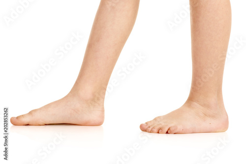 Side-view photo of little boy barefoot deformed legs