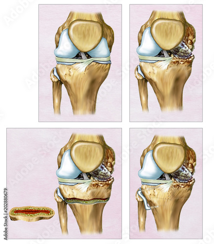 Ilustración descriptiva una Osteotomía o corrección de la rodilla en donde el fémur y la tibia aparecen torcidas. La intervención quirúrgica es realizada  por traumatólogos para re alinear la rodilla. photo