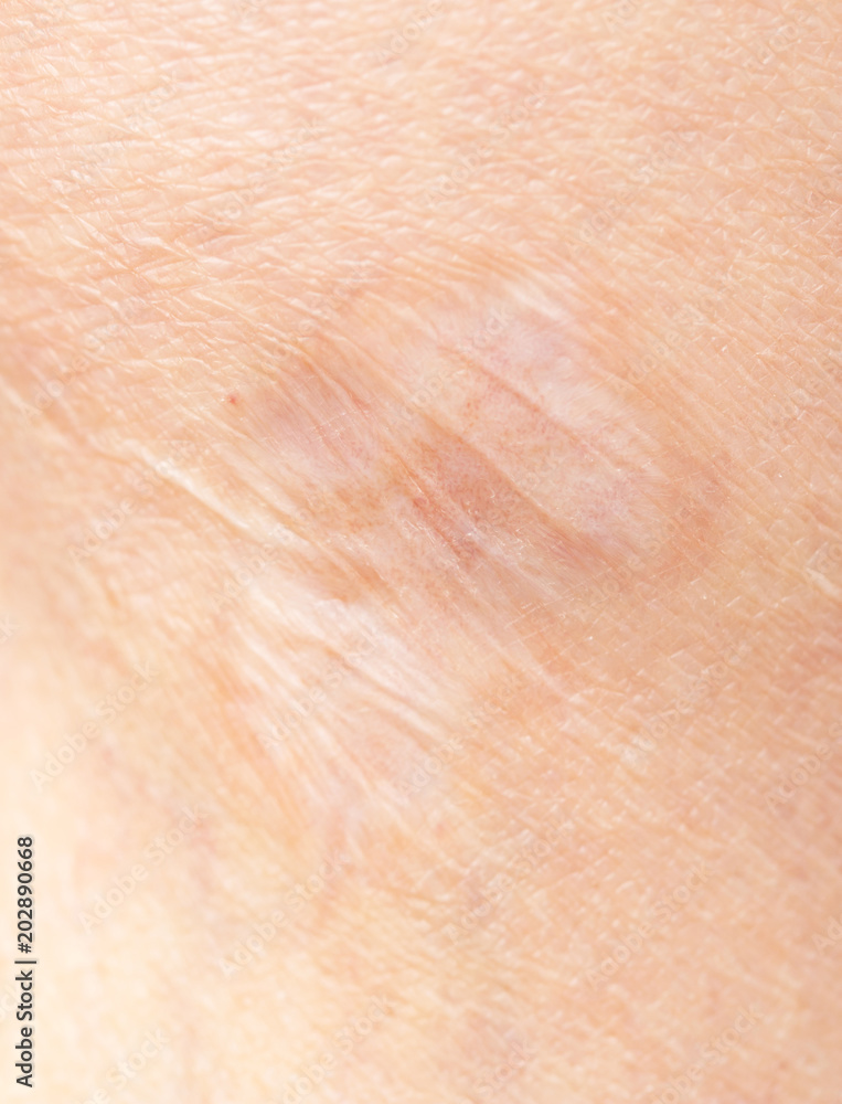 Fototapeta premium scar on the leg
