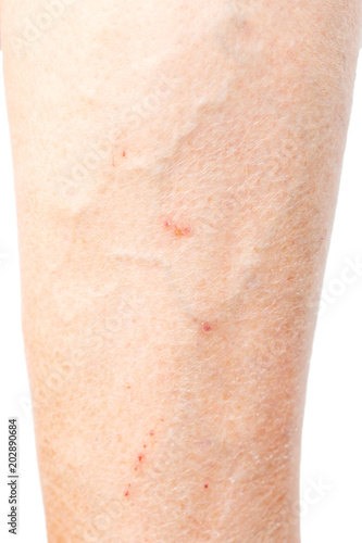 varicosity on the female leg