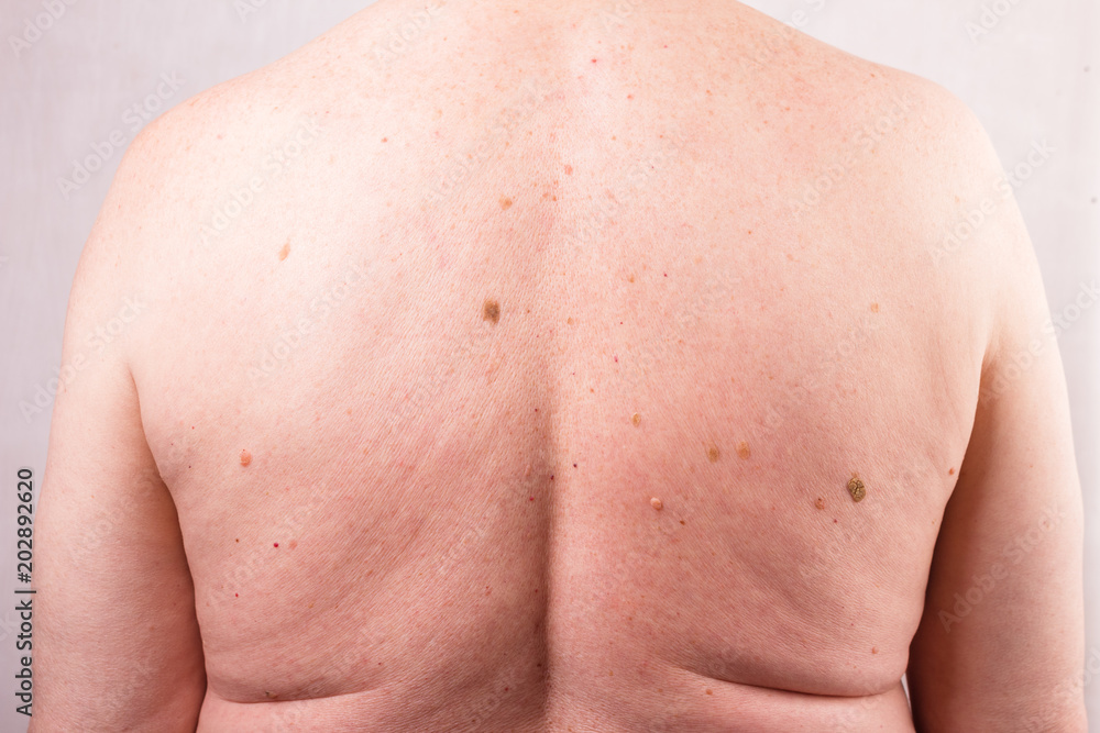 the doctor examines the birthmarks on the man's body the doctor examines the birthmarks on the man's body