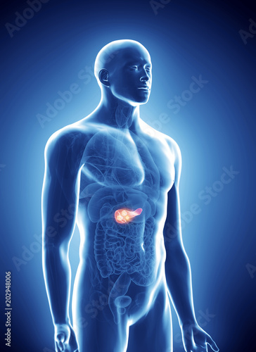 3d rendered, medically accurate illustration of pancreas cancer