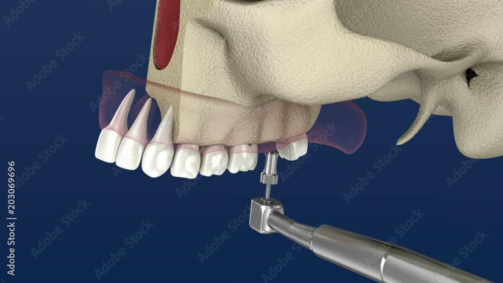 Sinus Lift Surgery - Sinus Augmentation. 3D Animation. Stock Video | Adobe  Stock