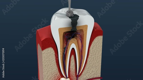 Root canal treatment process. 3D Animation. photo