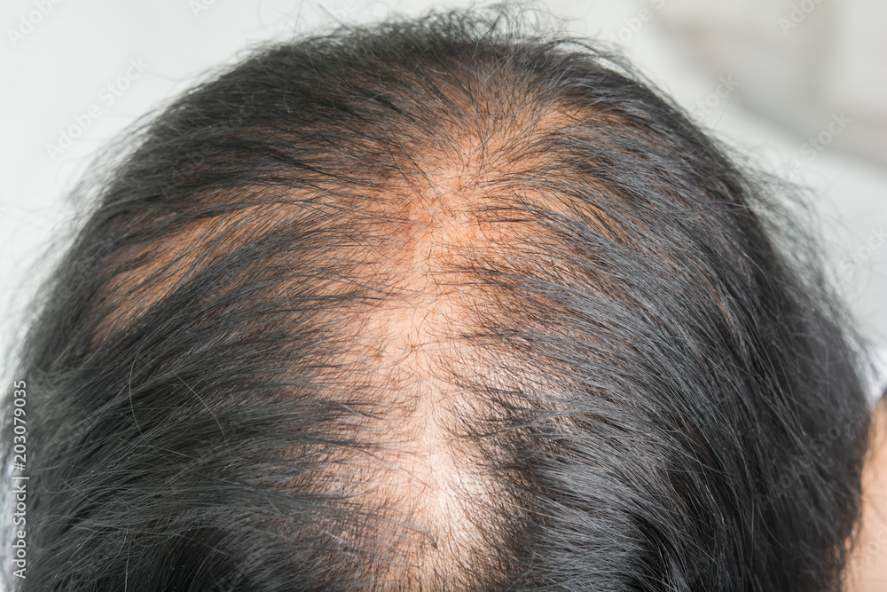 Thin hair and scalp problems and broken hair Stock Photo | Adobe Stock