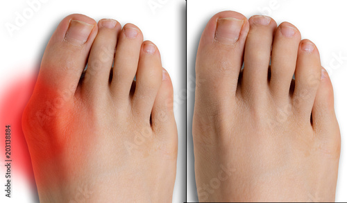 Pain caused by hallux valgus, comparison before and after surgery
