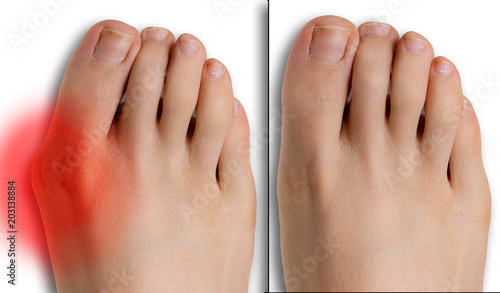 Pain caused by hallux valgus, comparison before and after surgery photo