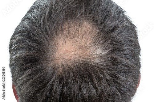male head with circular thinning hair or alopecia