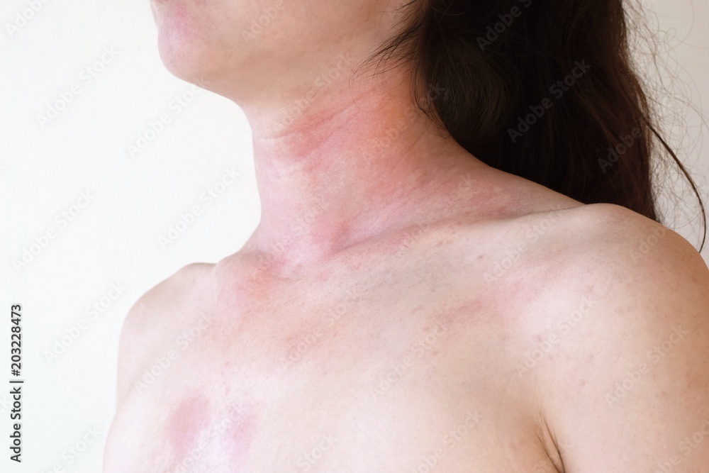 Allergic skin reaction on the female neck and face Allergic skin reaction on the female neck and face