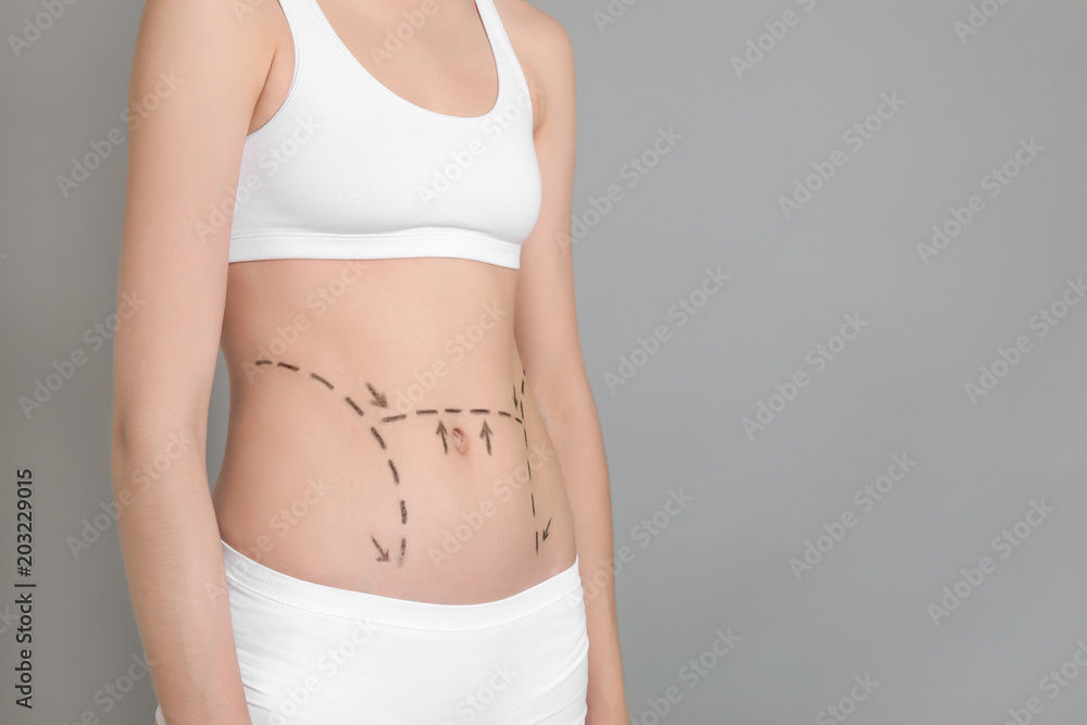 Young woman with marks on belly for cosmetic surgery operation against color background