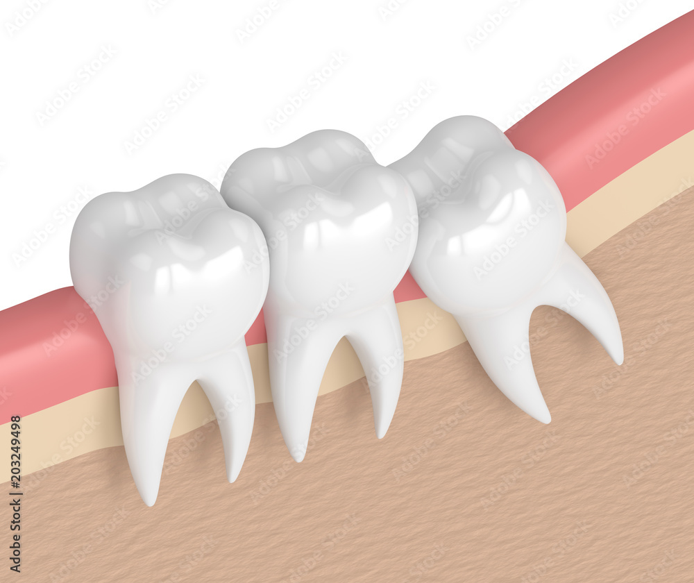 3d render of teeth with wisdom mesial impaction 3d render of teeth with wisdom mesial impaction