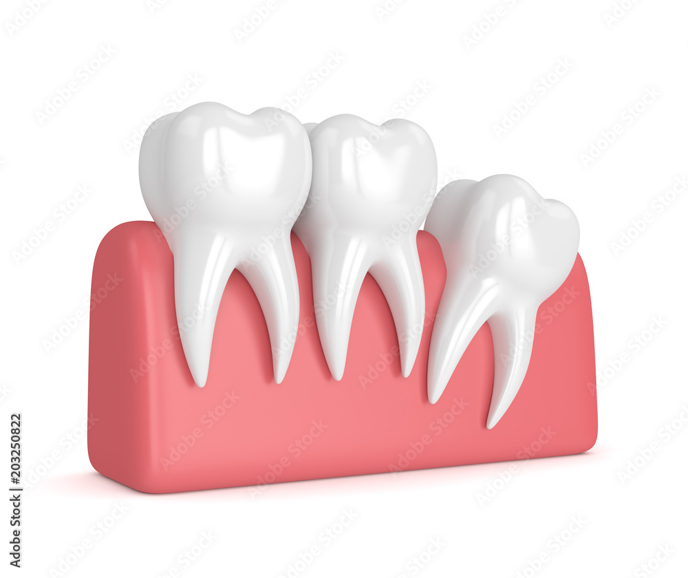 3d render of teeth with wisdom distal impaction 3d render of teeth with wisdom distal impaction