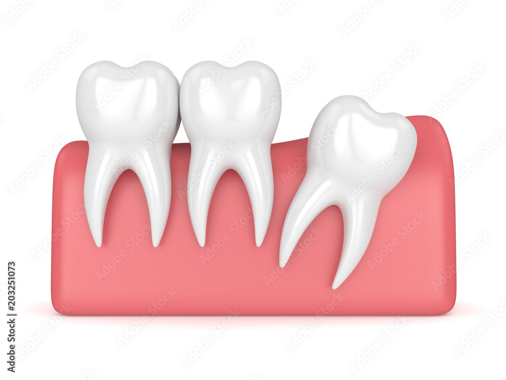 3d render of teeth with wisdom distal impaction 3d render of teeth with wisdom distal impaction