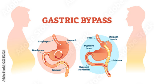 Gastric bypass medical surgery procedure vector illustration with esophagus, stomach, duodenum and jejunum flow. photo