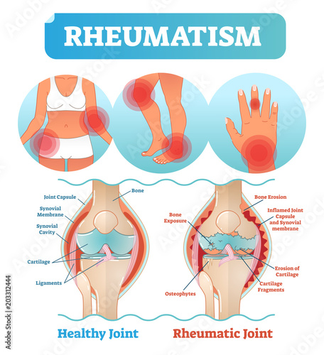 Rheumatism medical health care vector illustration poster diagram with damaged knee erosion and painful body joints.