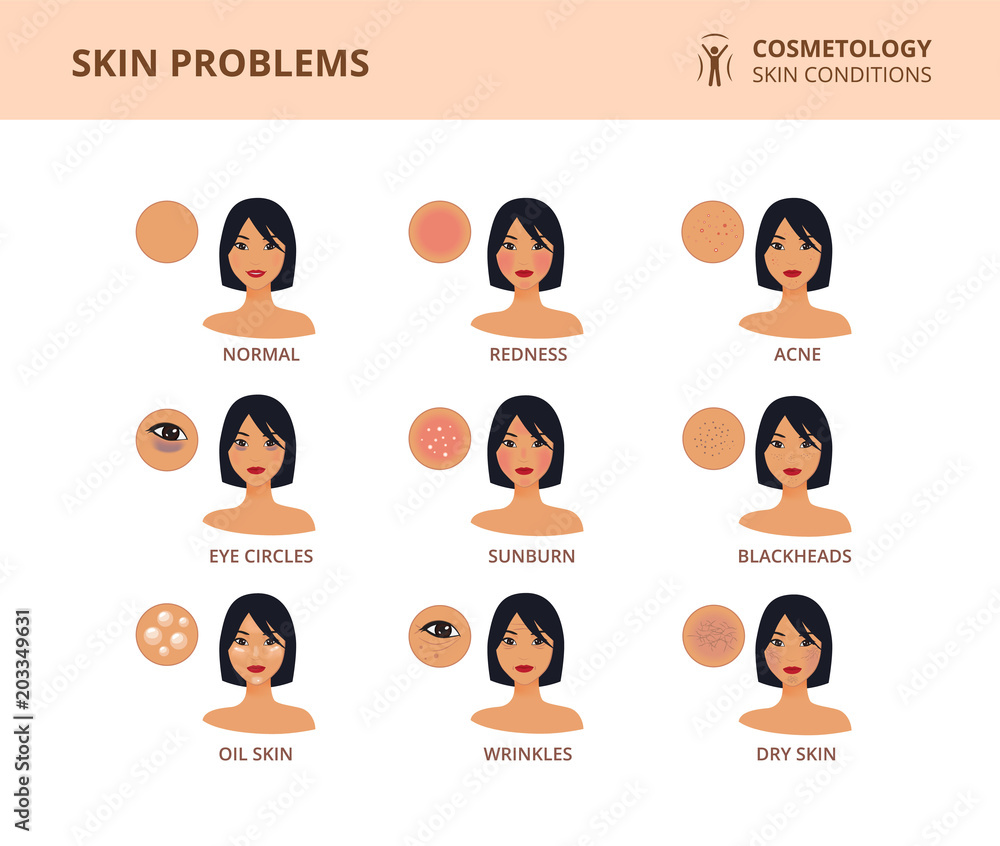 The most common female facial skin problems acne, wrinkles, dry skin