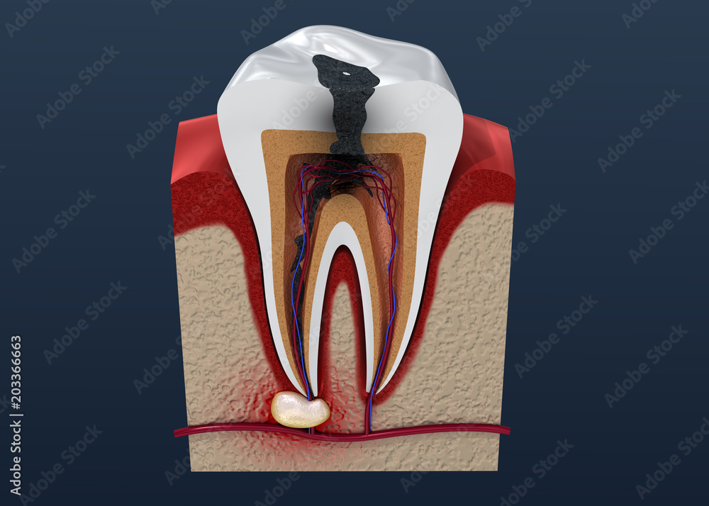Tooth decay. 3D illustration - obrazy, fototapety, plakaty 