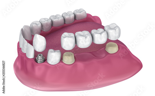 Tooth supported fixed bridge, implant and crown. Medically accurate 3D illustration photo