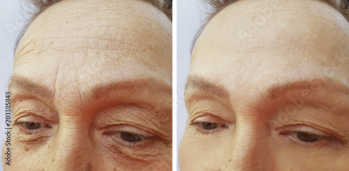 face woman elderly wrinkles before and after