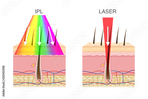 The difference of using IPL light and laser in hair removal. Illustration about beauty technology.