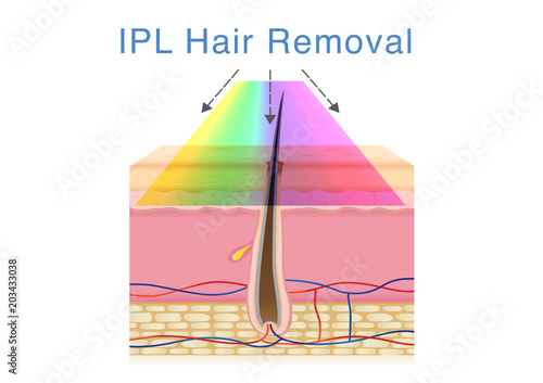 Using IPL light for hair removal on human skin. Illustration about beauty technology.
