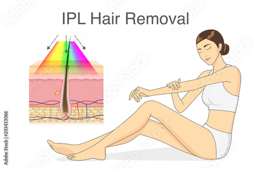 IPL light for hair removal on skin layer and beauty woman touching her skin. Illustration about cosmetic technology.