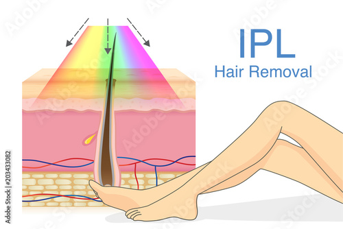 IPL light for hair removal on skin layer and woman leg. Illustration about cosmetic technology.